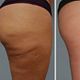 Healing cupping Cellulitis benen en poep + butt lift
