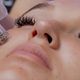 Microneedling