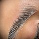 Brow lift