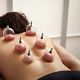 Cupping