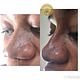 Non surgical  rhinoplasty (nose )N210,000)
