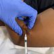Keloid and scar treatments  50,000