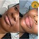 Lip fillers (N180k)