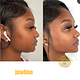 Jawline filler (180k per ml) (3 used)