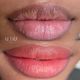 Upper lip (Per Session)