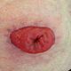 Stomazorg, Stoma irrigatie en Darmspoeling