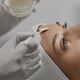 Chemical Peel Treatment