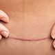 Scar Treatment