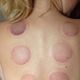 1 hour sports massage with myofascial cupping