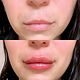 0.5ML Lip Filler