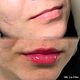 1ML Lip Filler