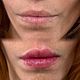 1.5ML Lip Filler