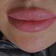 1ml Chin Filler
