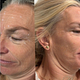 Botox 3 Areas