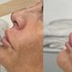 Non Surgical Rhinoplasty
