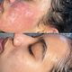 Acne Scar Treatment
