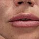 1ml Lips