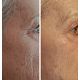 Korting Anti-Aging  Glow behandeling + Gratis Huidanalyse nu actie van 225€ Naar 99€