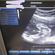 Pelvic Ultrasound