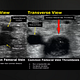 AV DUPLEX SCAN (BOTH LEGS)