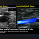 VENOUS OR ARTERIAL  DUPLEX SCAN (Both legs)