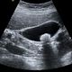 Whole Abdomen