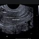 TVS Transvaginal Ultrasound