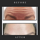 Anti-Wrinkle injections 💉