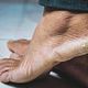 Pedicure Verwaarloosde voeten