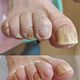 Medische pedicure met kalkbehandeling