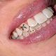 Tooth Gems