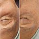DS V-line collageendraden gelaat en hals