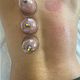 Cupping massage
