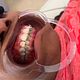 Brace Removal
