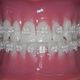 Top & Bottom Ceramic Braces
