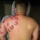 Cupping massage