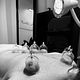 Dry cupping