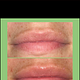 Lip Rejuvination Therapy