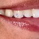 Tooth Gem Application