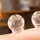 Cuppingtherapie openingsactie