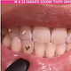18kt & 22kt Gouden Tandsieraad