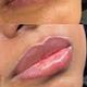 Lip Neutralisatie