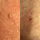 Skin tag removal per tag