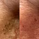Black head extraction with mini facial