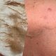 Dermaplaning