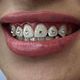 6 teeth with single gems