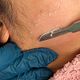 DERMAPLANING