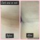 Microdermabrasion on Neck