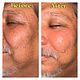 Microdermabrasion