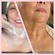 Neck & Chest Microdermabrasion